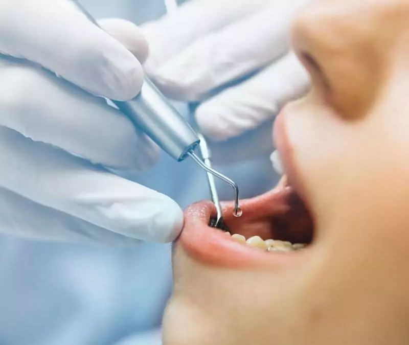 How Much Does Teeth Cleaning Cost in Weston, FL? [2026 Guide]