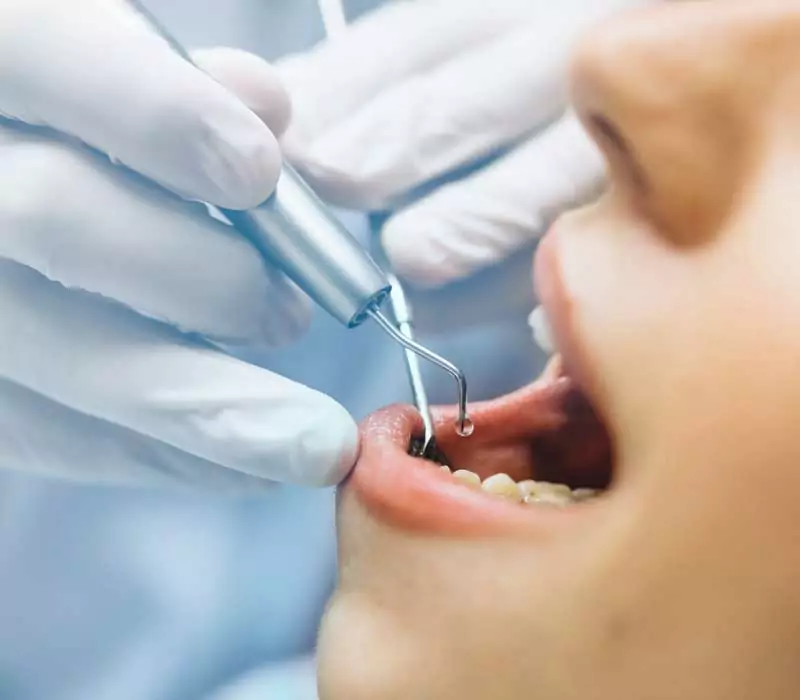 Home 8 Deep-Cleaning-Periodontics-Dentist-in-Weston-Fl-Family-Cosmetic-Dentistry-800-x-700