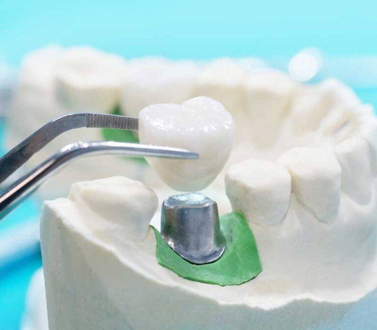 What Is a Dental Crown? When You Need One and What to Expect in Weston, FL 3 What Is a Dental Crown? When You Need One and What to Expect in Weston, FL