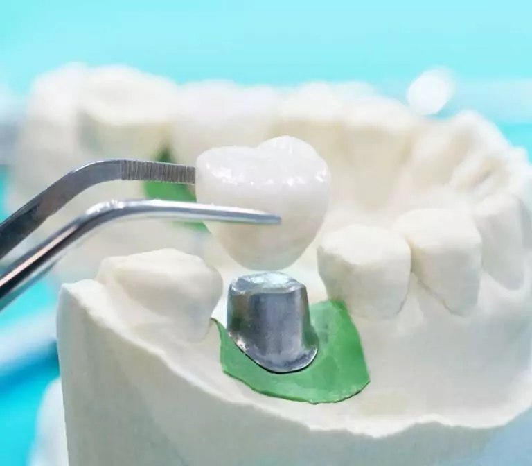 What Is a Dental Crown? When You Need One and What to Expect in Weston, FL 3 What Is a Dental Crown? When You Need One and What to Expect in Weston, FL