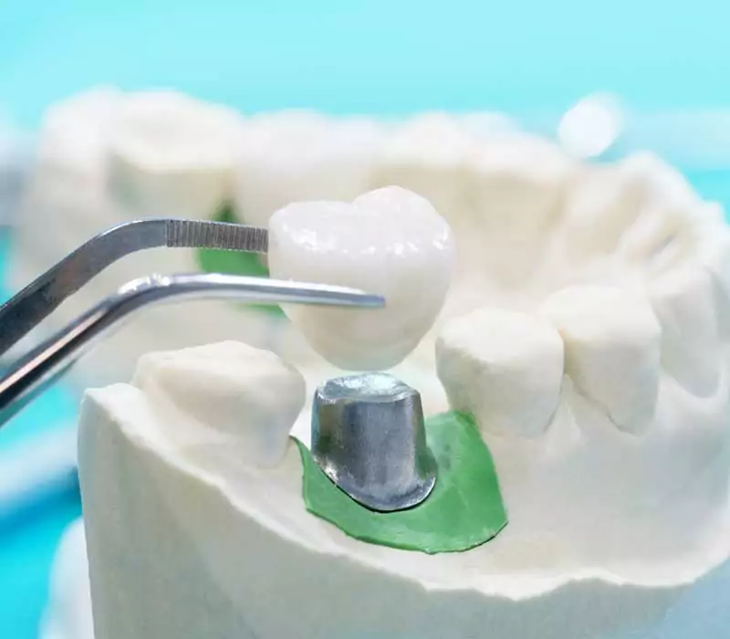 Dental-Crowns-Restorative-Dentistry-Dentist-in-Weston-Fl Dental-Crowns-Restorative-Dentistry-Dentist-in-Weston-Fl