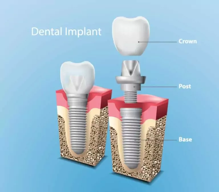 How Much Do Dental Implants Cost in Weston, FL? (2026 Guide) 6 How Much Do Dental Implants Cost in Weston, FL? (2026 Guide)