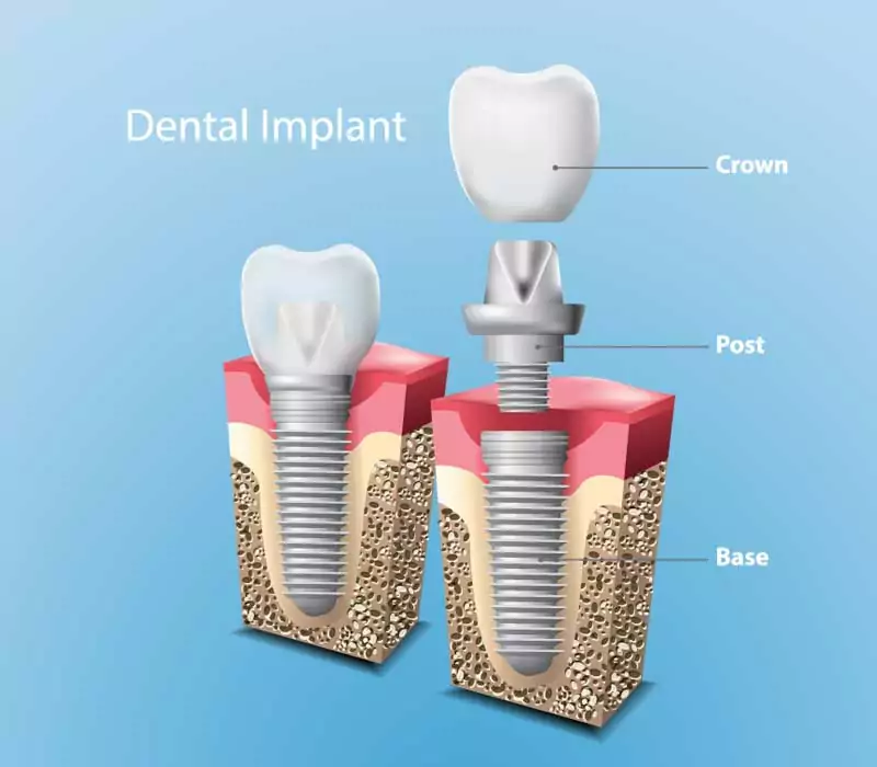 Dental-Implants-Restorative-Dentistry-Dentist-in-Weston-Fl Dental-Implants-Restorative-Dentistry-Dentist-in-Weston-Fl