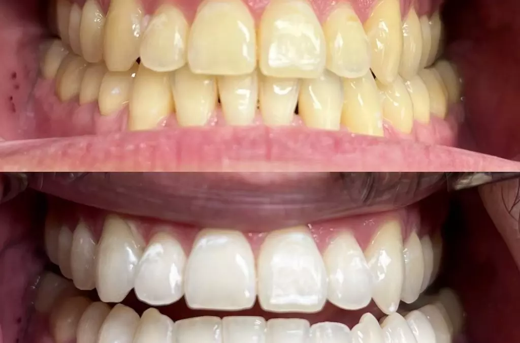 Can teeth whitening cause permanent sensitivity?