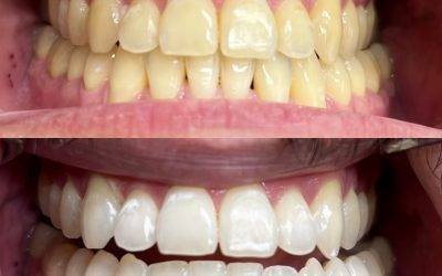 Can teeth whitening cause permanent sensitivity?