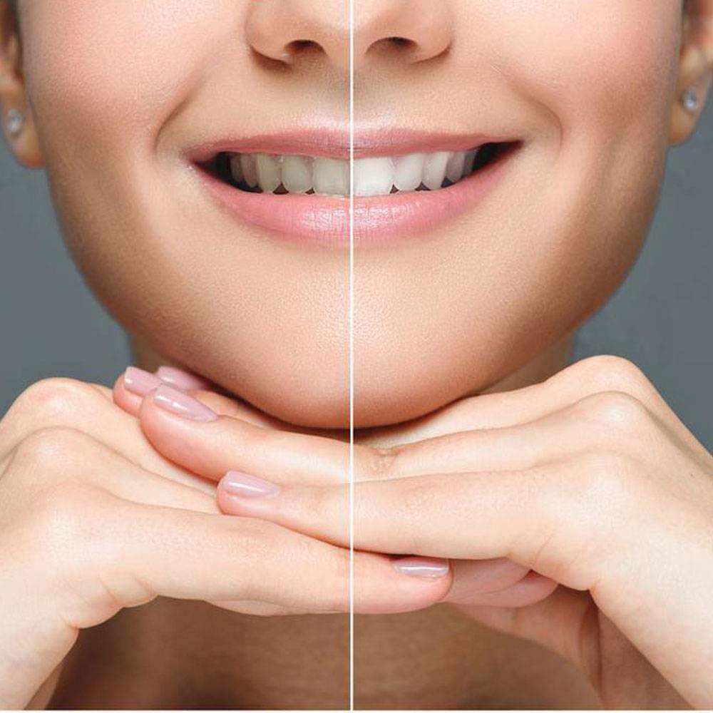 teeth-whitening-in-office-results - Does whitening toothpaste damage teeth